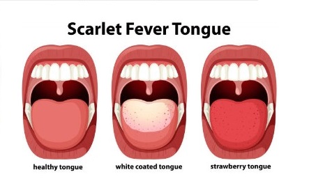 성홍열 혀 증상 체크