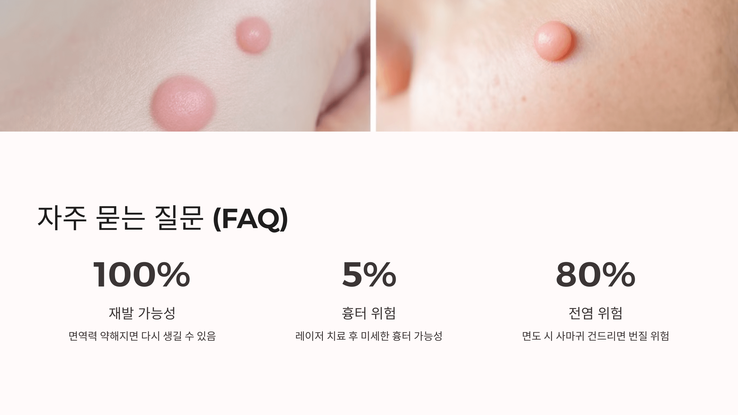 편평사마귀와 관련된 사진입니다.