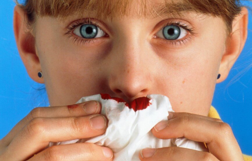 코피가 계속 나는 여성