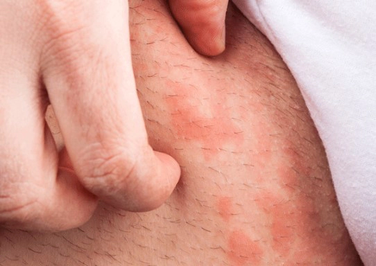 아토피 가려움증 해소방법 11가지 및 아토피에 좋은 오일 추천