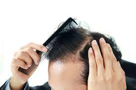 바이오틴 탈모샴푸 추천 효과 (내돈내산 솔직후기)