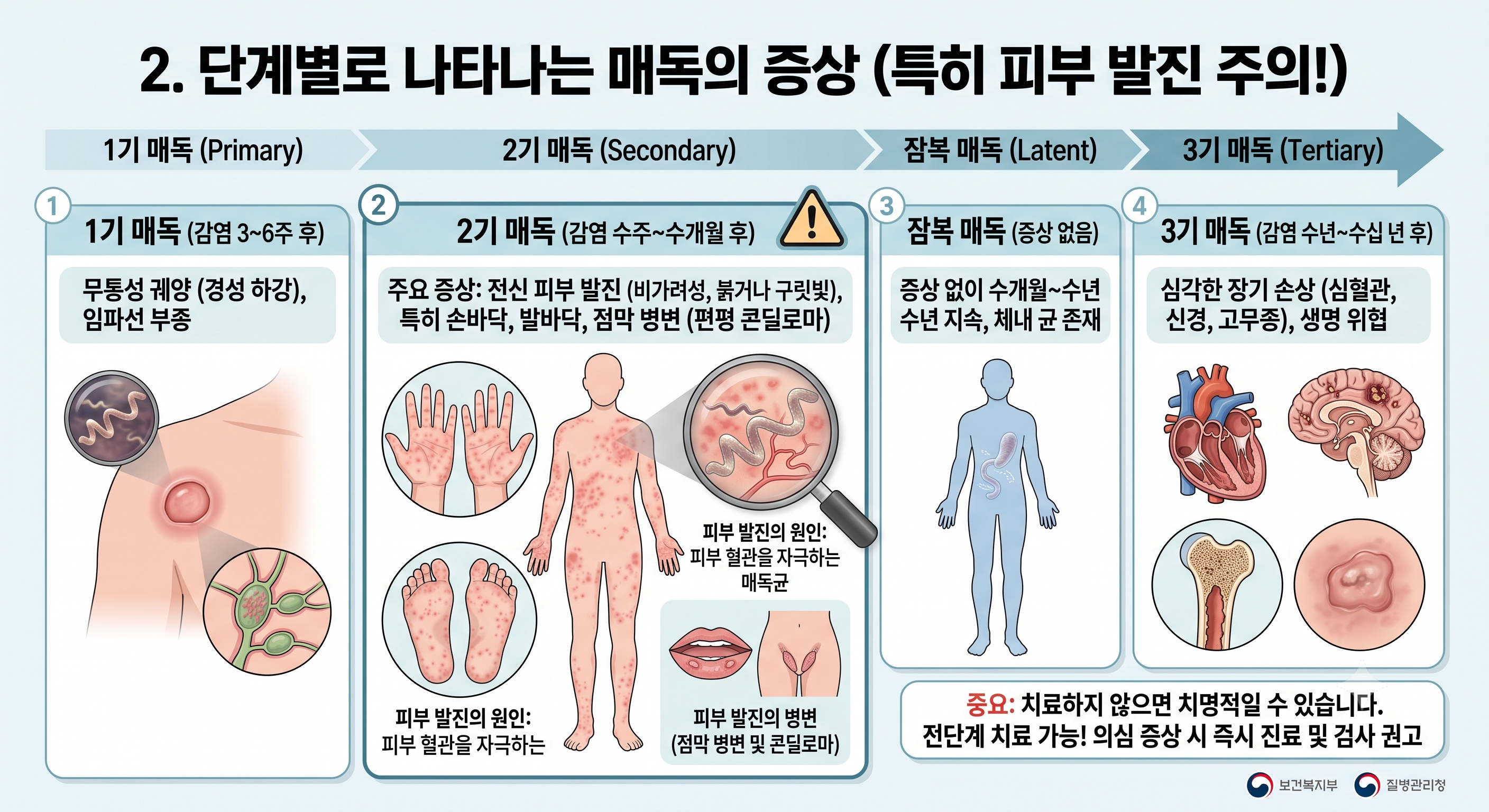 단계별 매독의 증상