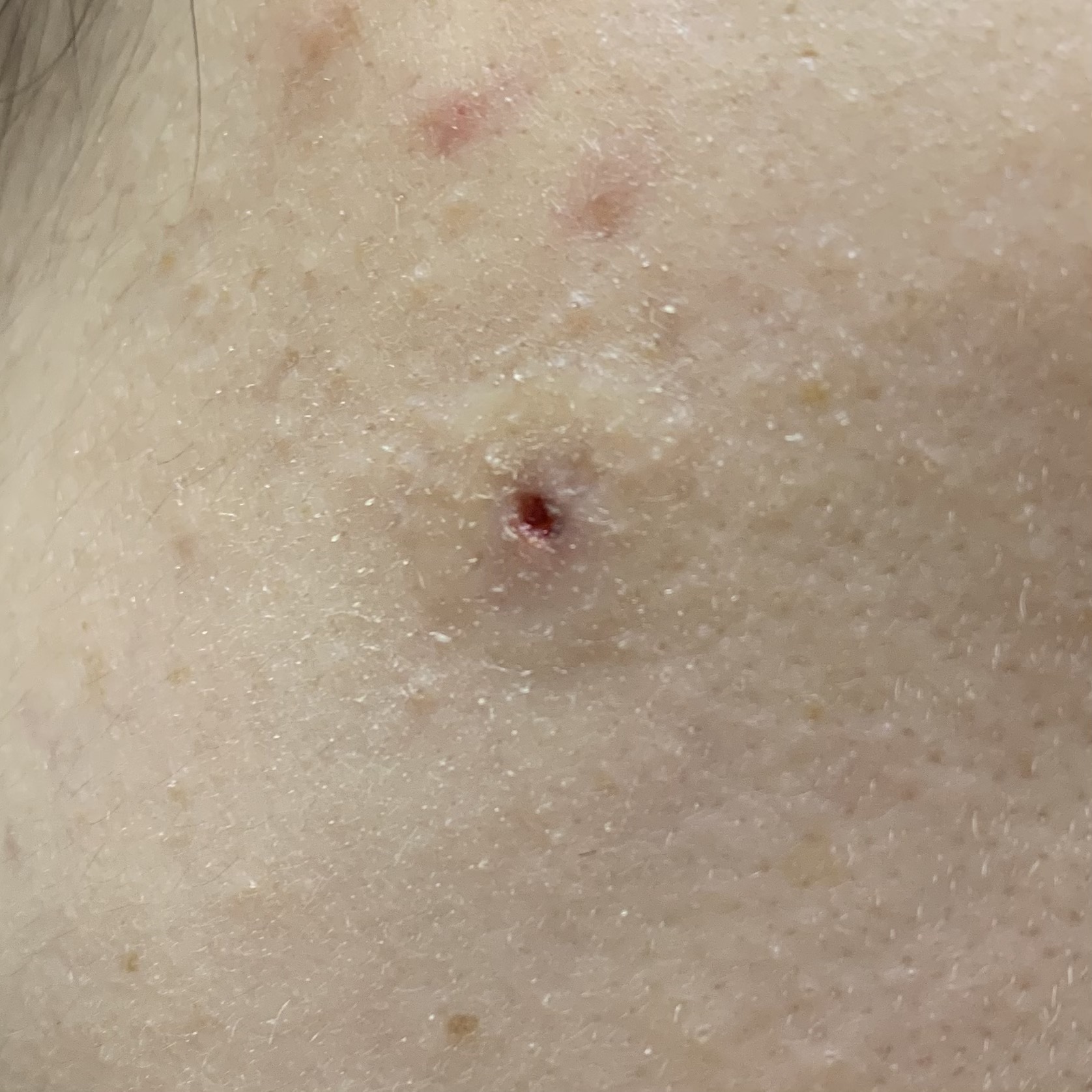 피지낭종 수술5일차