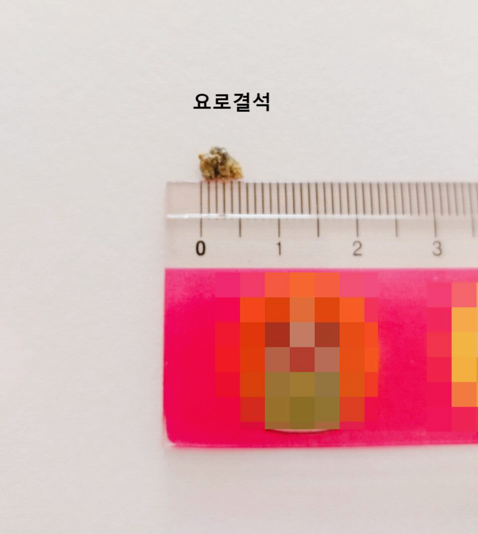 소변으로 나온 결석의 크기