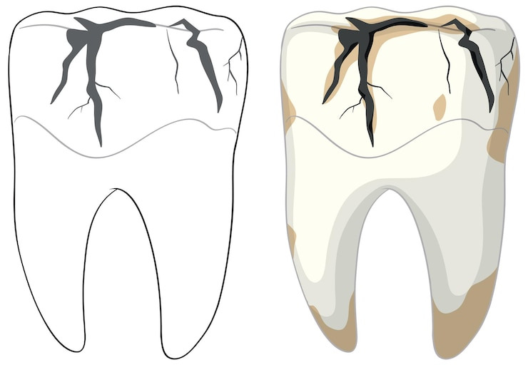 치아에 금이 간 사진, 관리가 안되어 있는 사진
