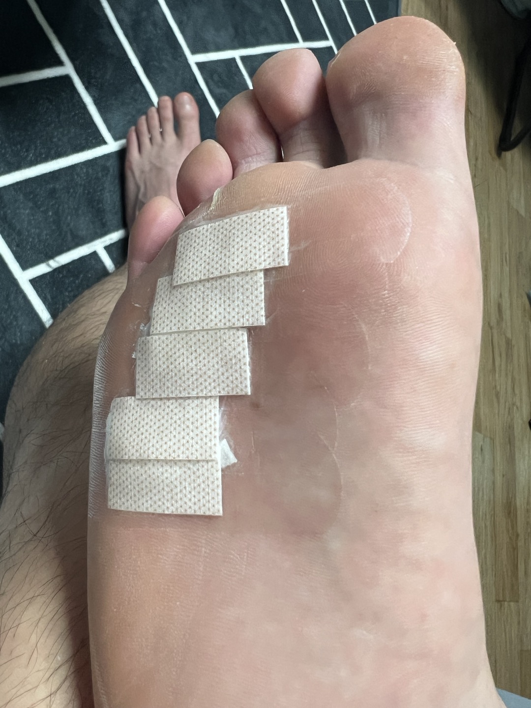 발바닥 사마귀 자가치료