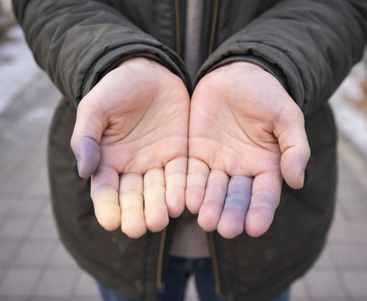 레이노 현상과 손발내증, 동상 차이 한눈에 정리하기 관련 사진
