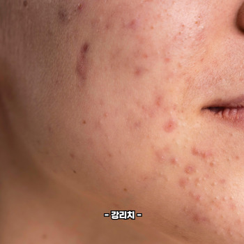 여드름 빨리없애는 방법