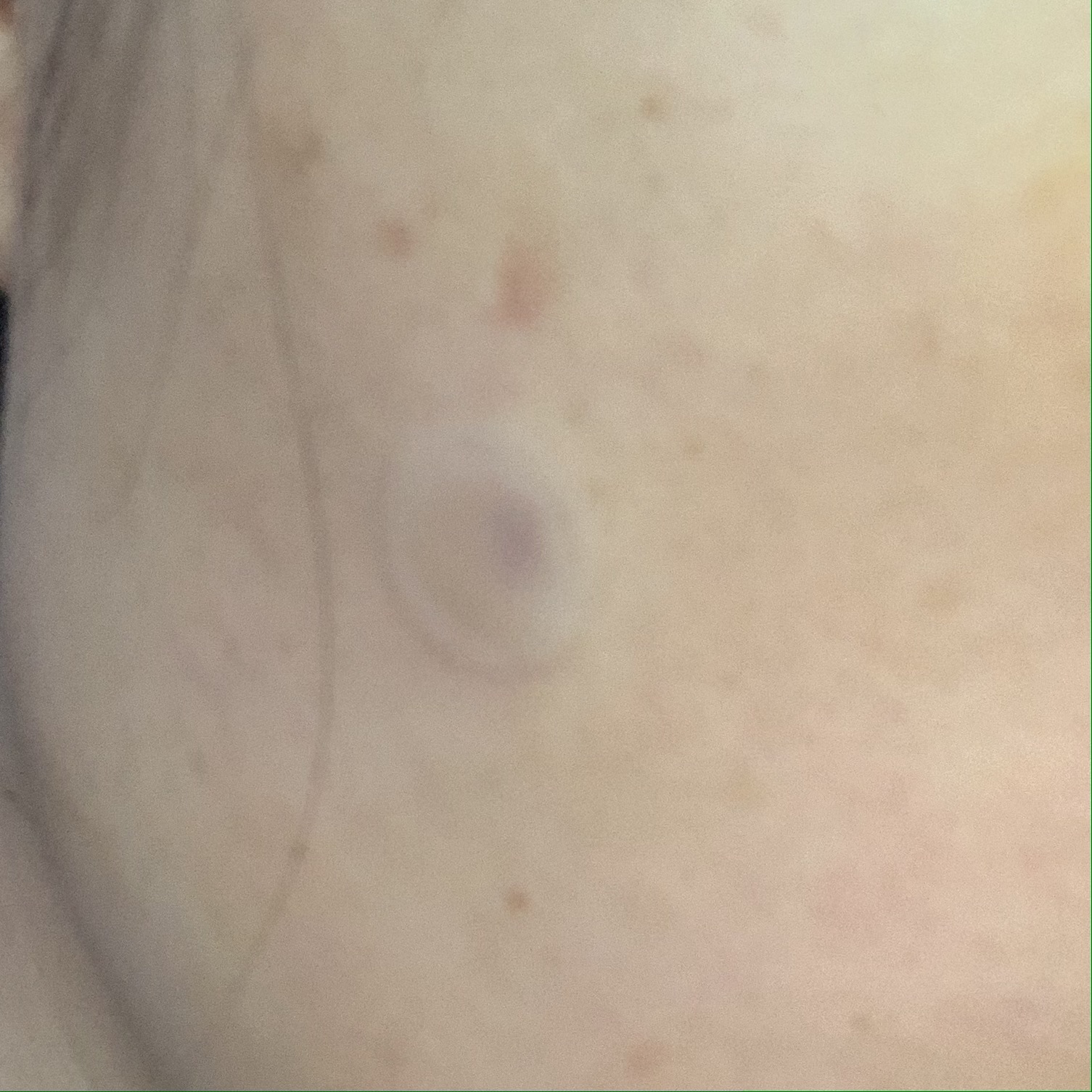 피지낭종 수술직후