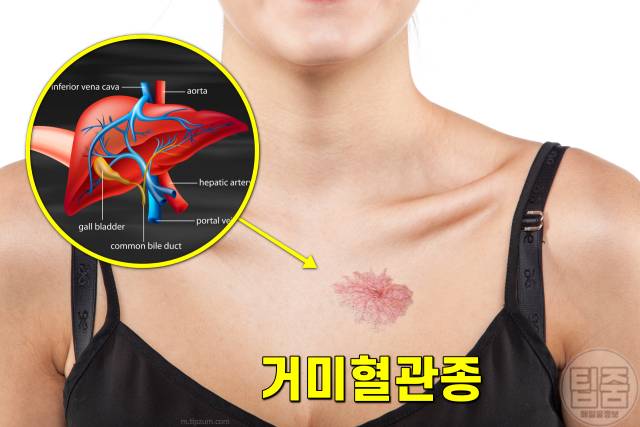 간이 안좋으면 나타나는 증상,가슴 거미모양 혈관종,간경화 증상,간이안좋은증상,팁줌