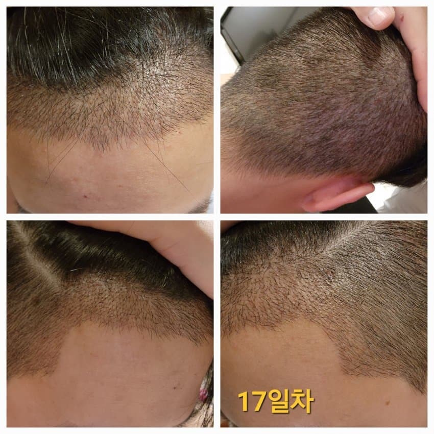 모발이식 후기
