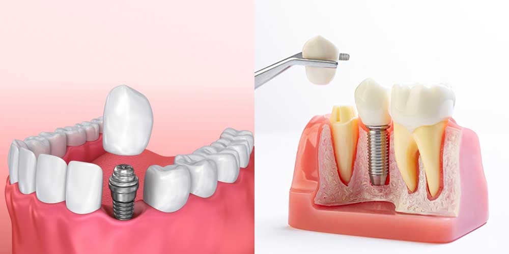 임플란트-가격-비용-싼-곳에서-어금니-앞니-수술하면-얼마