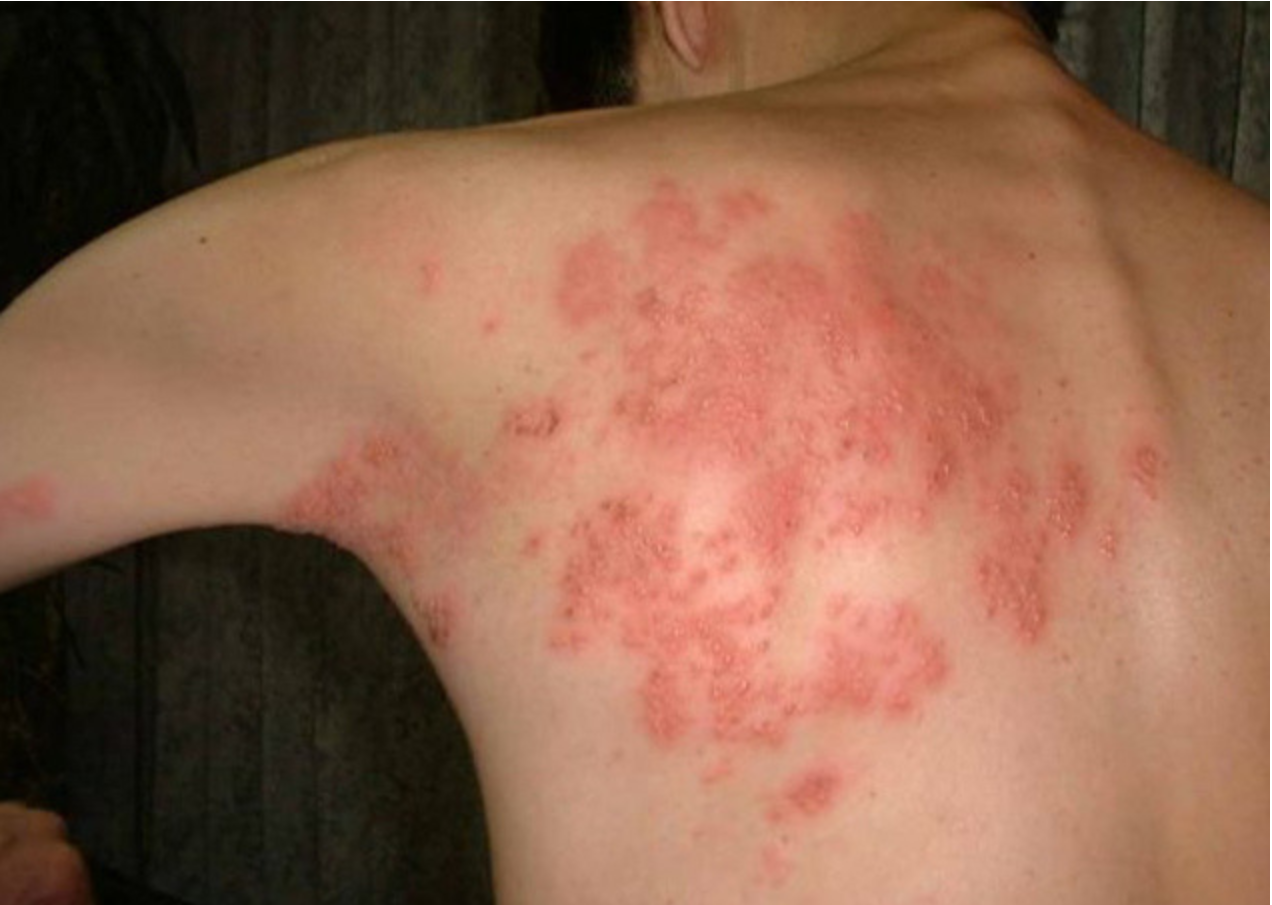 초기 치료 시점 놓치지 않는 방법