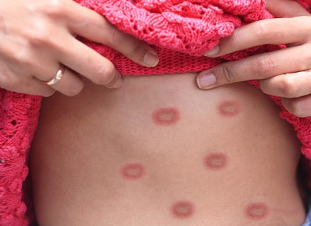 원숭이두창 바이러스 엠폭스(MPOX)&amp;#44; 초기증상&amp;#44; 수포&amp;#44; 후유증&amp;#44; 치사율&amp;#44; 예방접종 등