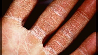 손바닥에-각질이-심하게-발생하였습니다.