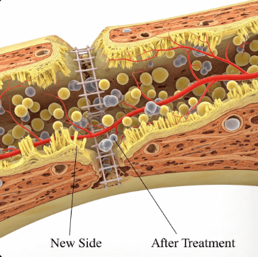 골다공증 원인별 치료방법12