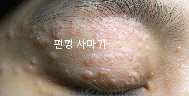 편평 사마귀는 주로 20대 여성의 얼굴, 팔 등에 잘 생깁니다.