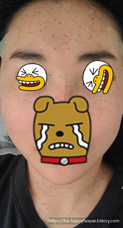 편평사마귀 시술 4일 차