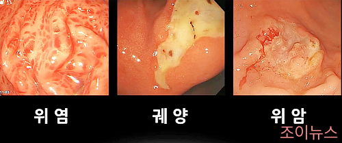 헬리코박터균의 발병원인