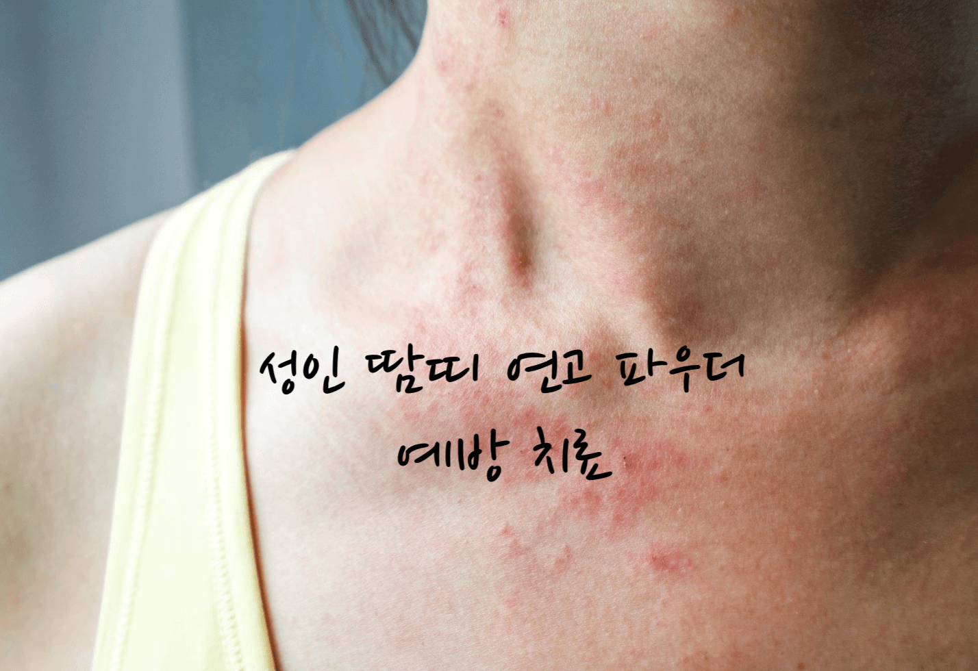 성인 땀띠