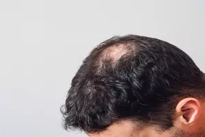 원형탈모