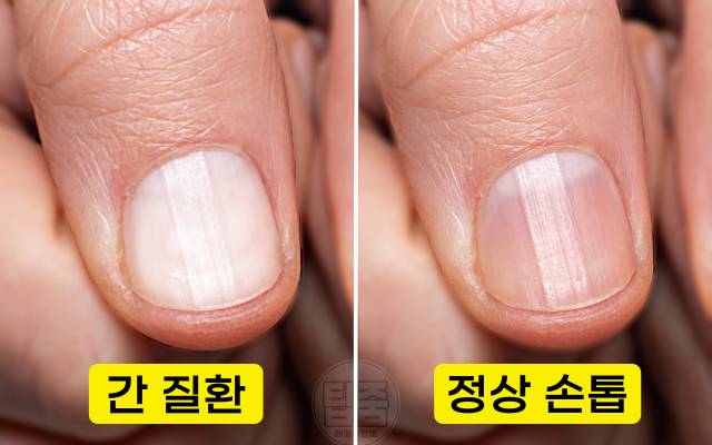 손톱 색깔 건강 손톱색깔 보라색 노란색 파란색 흰색 검은색 원인