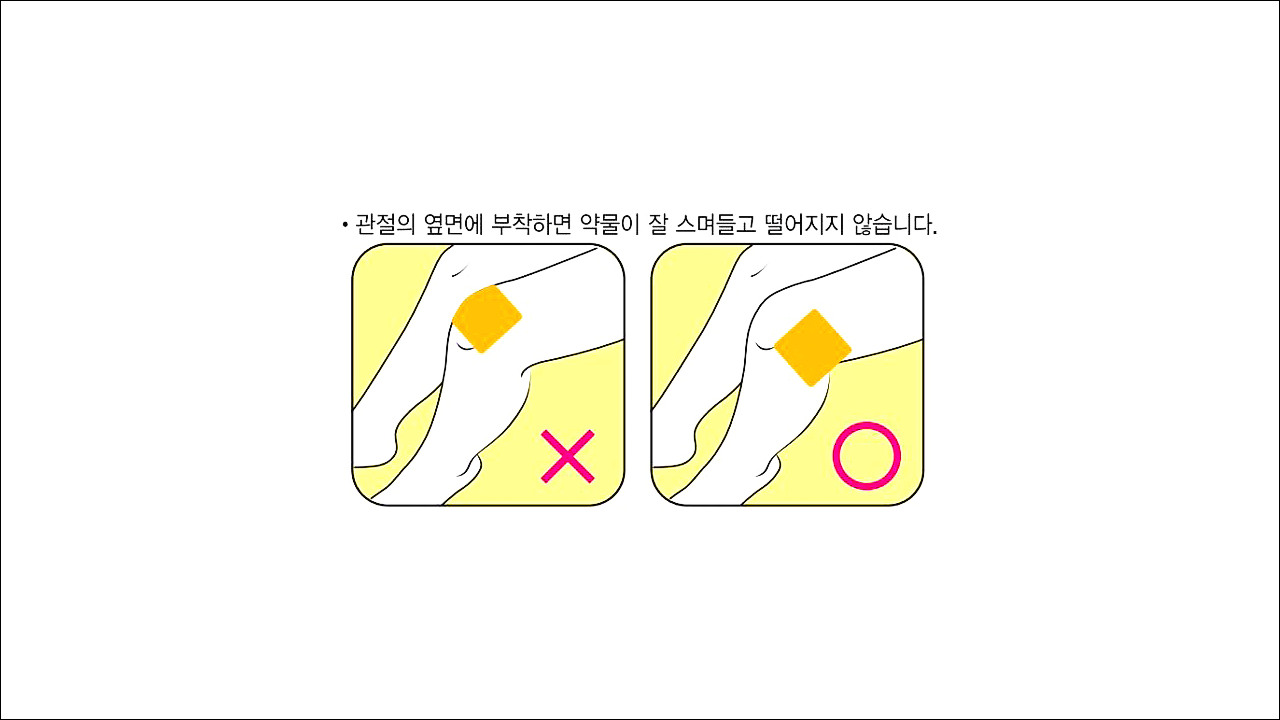 관절염, 근육통 치료제 트라스트패취(Trast Patch)