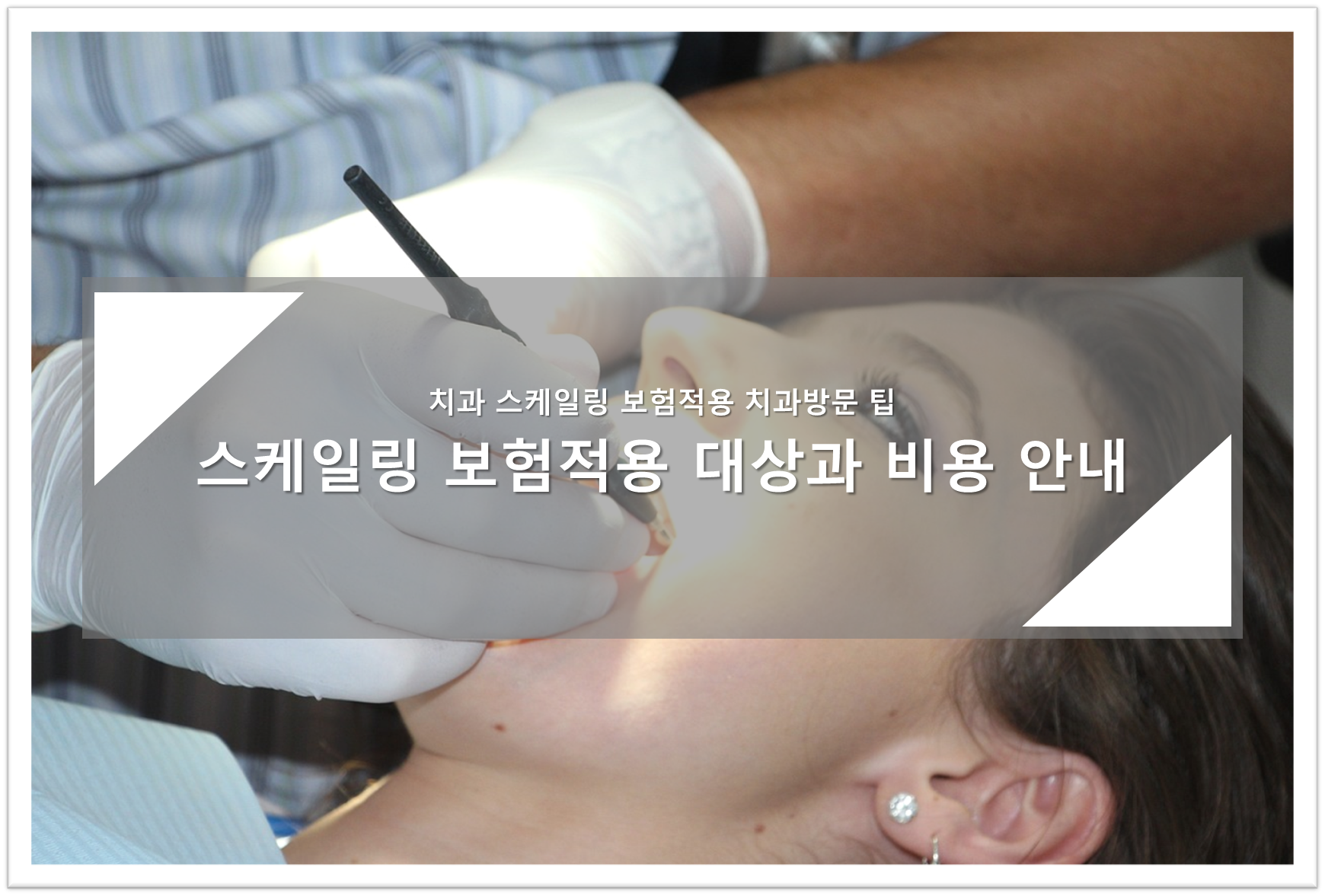 스케일링 보험적용 대상과 비용 안내