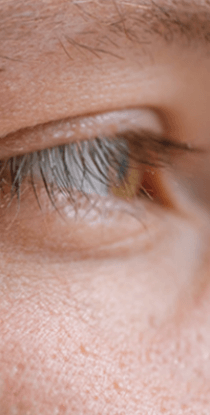 눈밑에 하얀 좁쌀