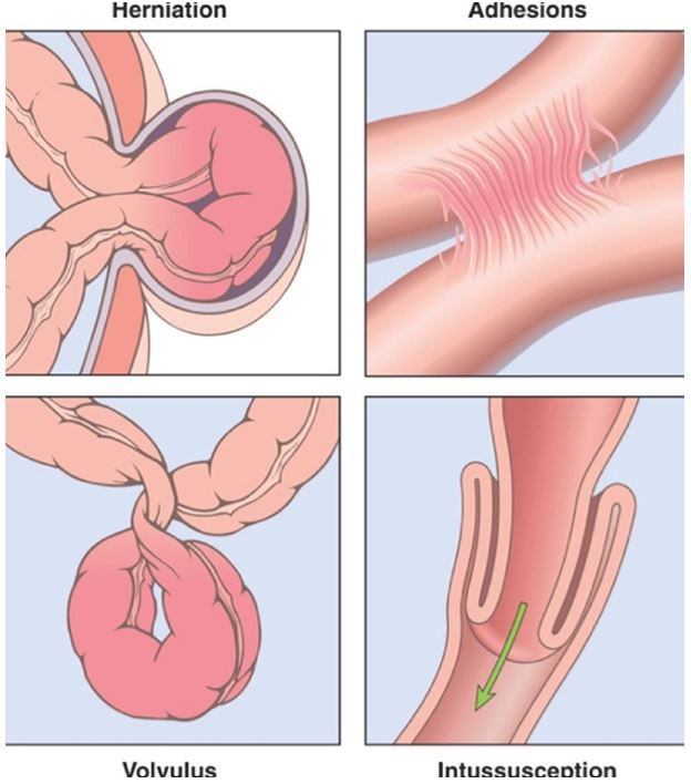장폐색 증상