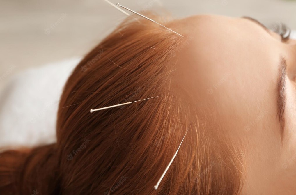 두피침효과
두피침술효과
머리카락이얇아지는이유