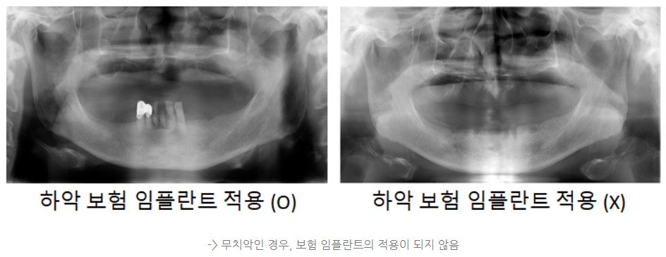 임플란트 건강보험