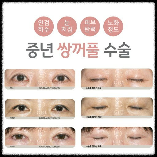 중년의 눈처짐&amp;#44; 쌍꺼풀 수술로 해결할 수 있을까요?