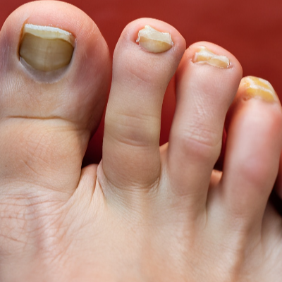 2. 발톱무좀 자가치료