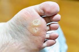 티눈이 생기는 이유