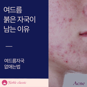 여드름 없애기
