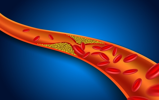 혈관건강 호모시스테인 15분운동 시계운동법 혈관청소 동맥경화예방 고지혈증 혈관나이 저강도운동 건강관리 스트레칭방법