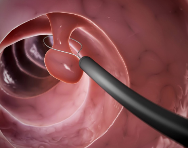 대장용종의 치료