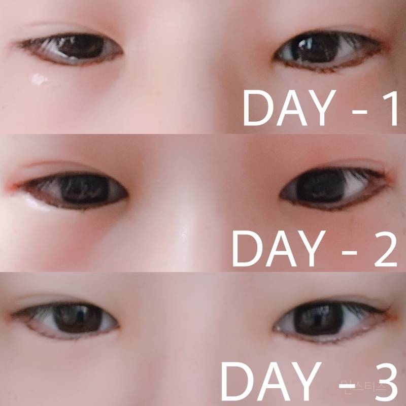 안검내반수술 후기