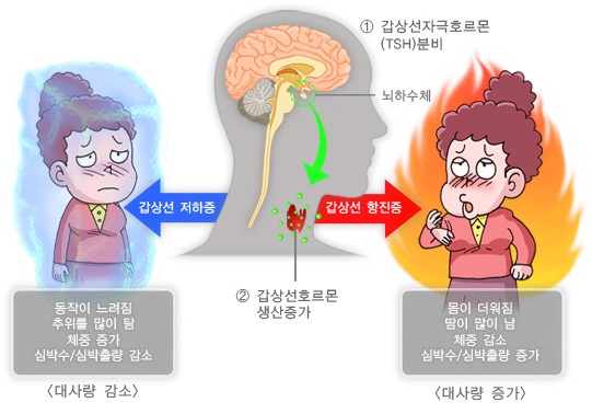 갑상선