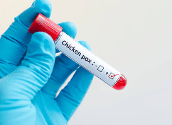 대상포진 예방접종 가격