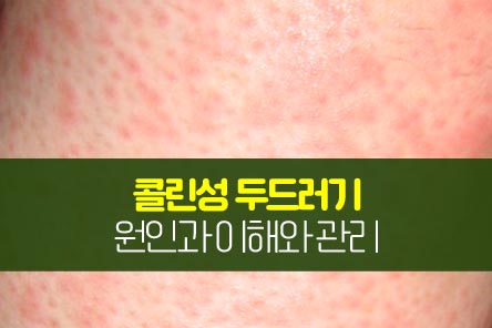 콜린성-두드러기-썸네일