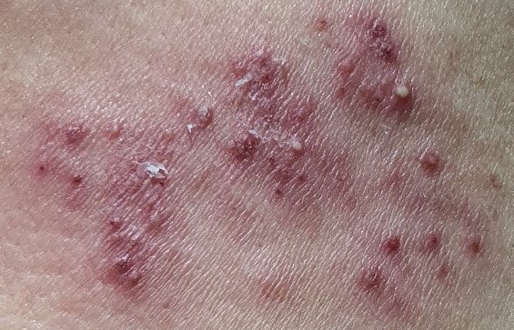 대상포진 수포 사진