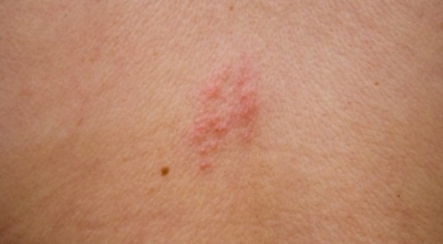 대상포진이미지