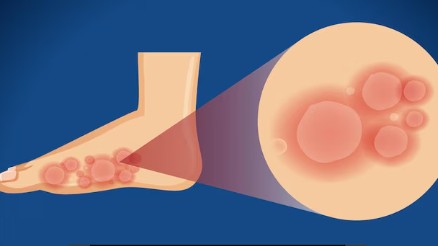 수포형-무좀-증상-생기는-원인-치료법-2