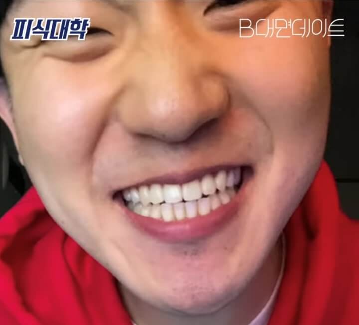 임플란티드-키드-치아-건치