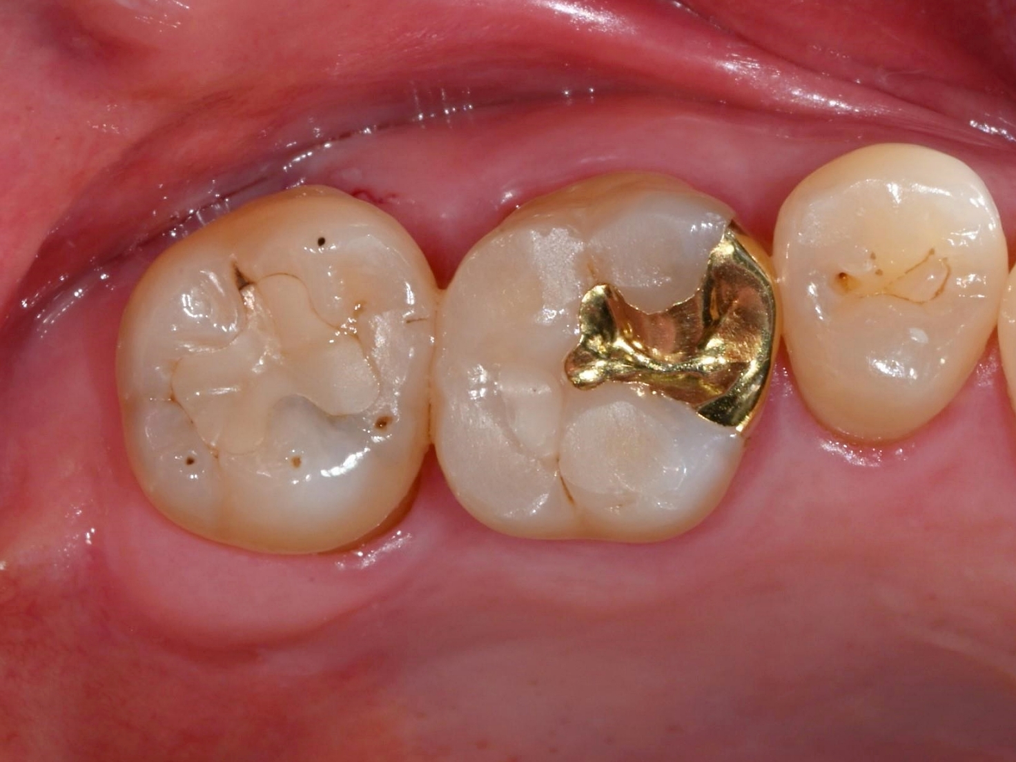 오래된 세라믹 인레이 하방에 발생한 어금니 깊은 2차 충치 진단 사진