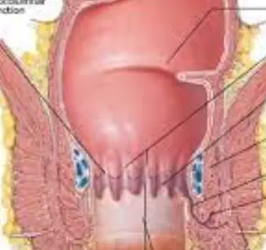 치질-증상-자가치료법-건강
