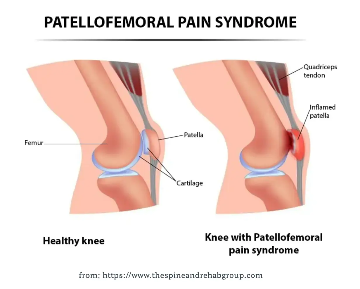 슬개대퇴통증증후군: 원인, 증상 및 효과적인 관리 방법