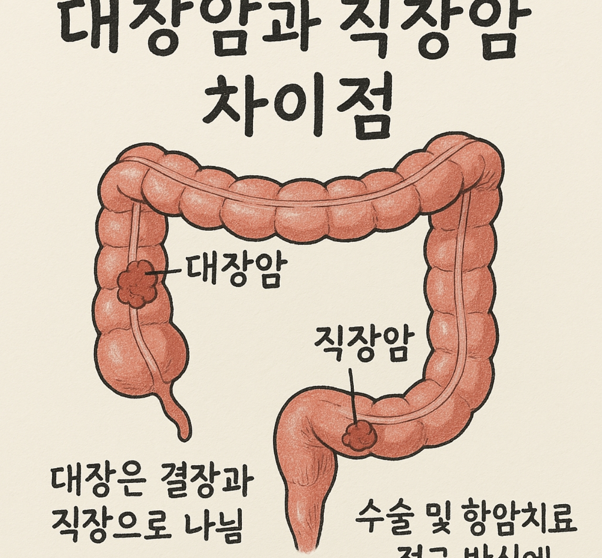 대장암과 직장암의 차이를 나타낸 사진
